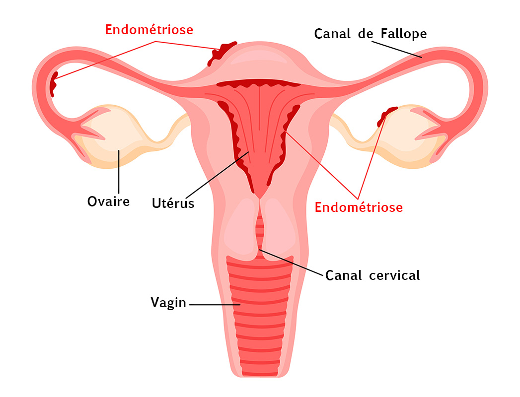 Utérus avec Endométriose